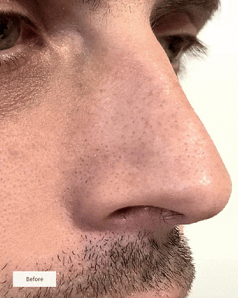 PureNose® - Parches hidrocoloides para poros limpios